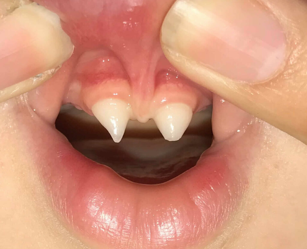 Denti displasia ectodermica